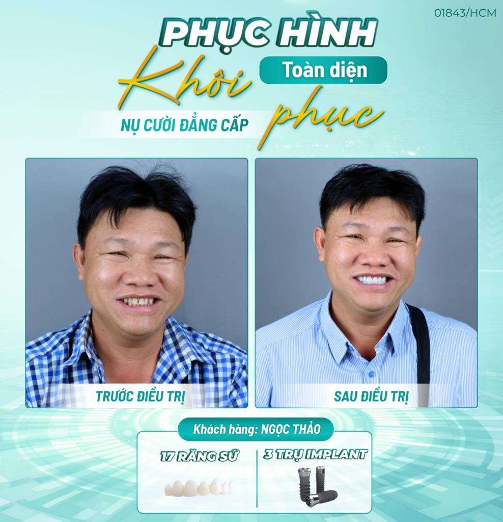dich vu implant