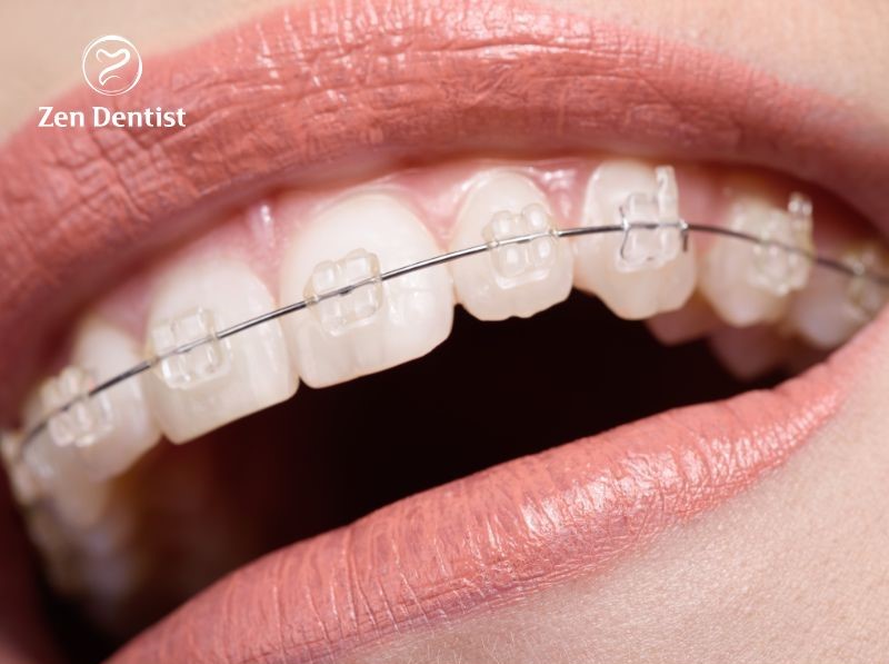 Bảng giá niềng răng phụ thuộc vào những yếu tố nào?