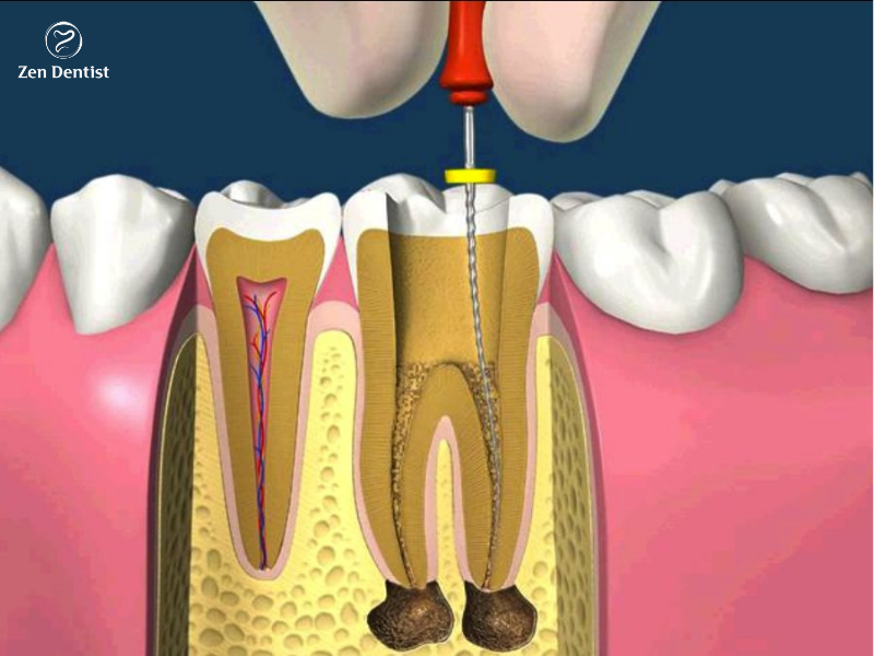 Điều trị tủy răng mất bao lâu? Chi phí điều trị bao nhiêu?