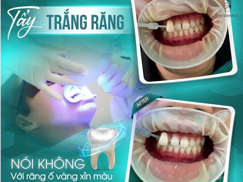 Có nên tẩy trắng răng không? Chi phí tẩy trắng răng tại TPHCM