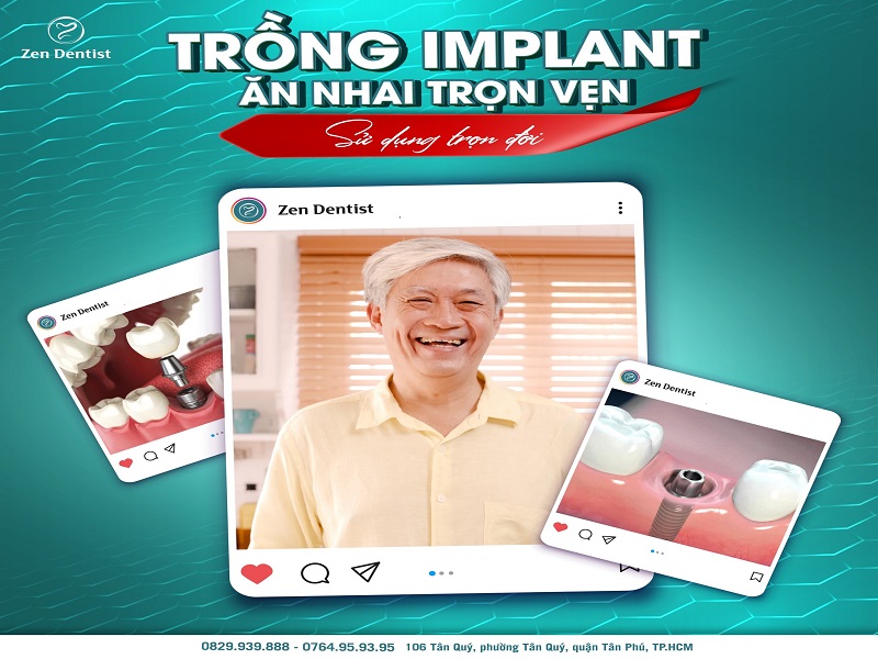 Trồng răng implant bao nhiêu tiền? Địa chỉ trồng implant uy tín TPHCM