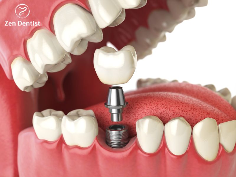 Trồng răng implant có đắt không và địa chỉ trồng implant giá tốt