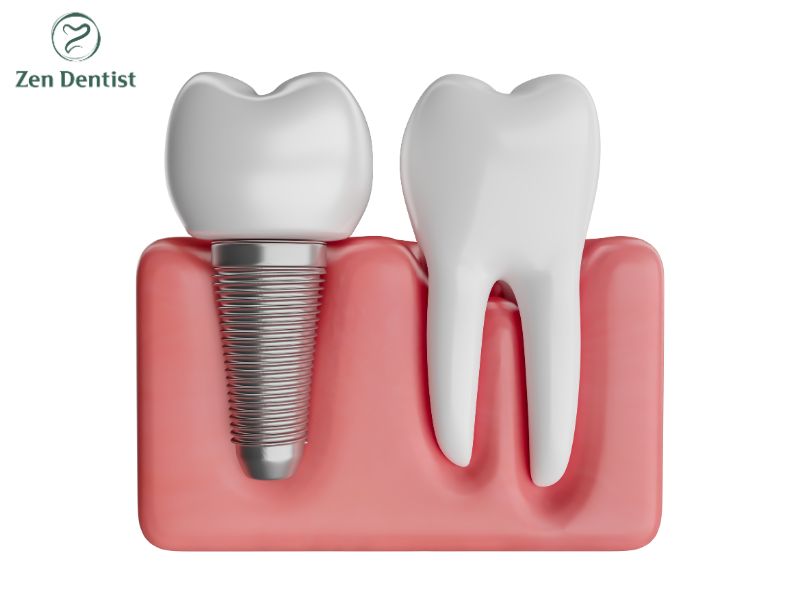 Tìm hiểu các công nghệ cấy implant hiện đại nhất hiện nay