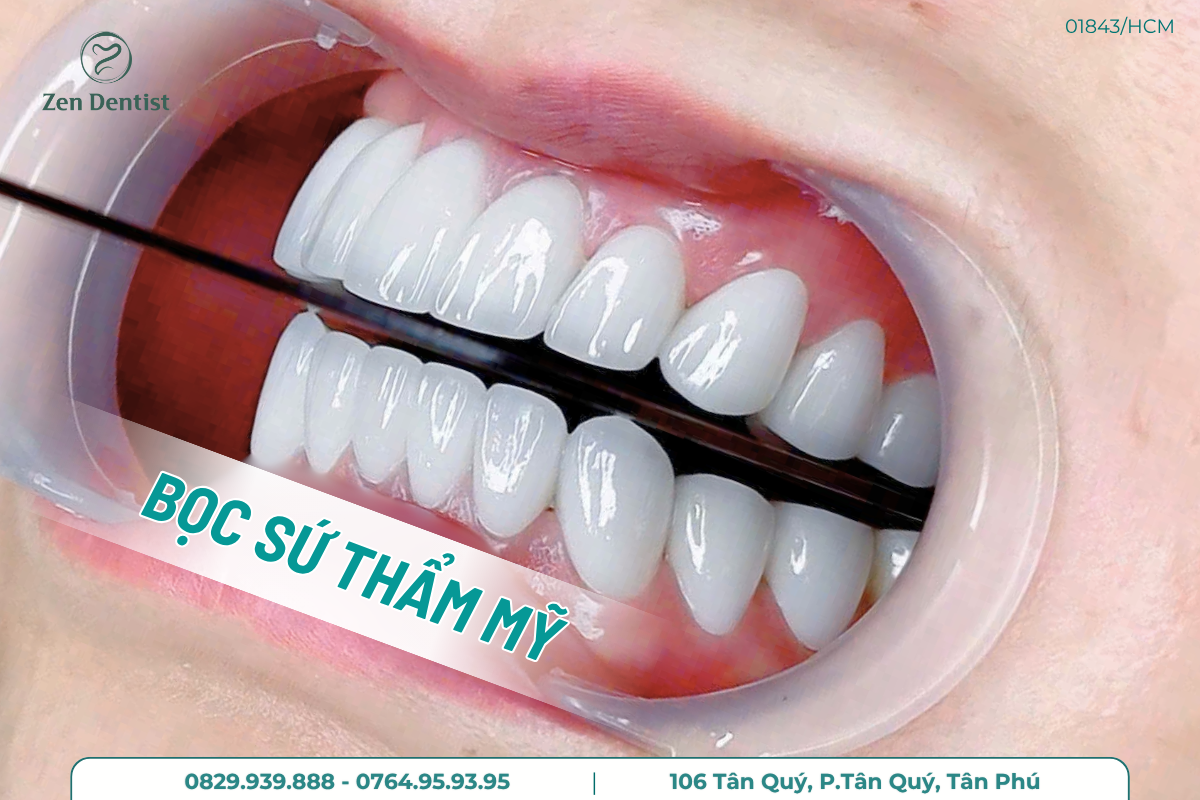 Bọc răng sứ giải pháp cho nụ cười trắng sáng, đều đẹp