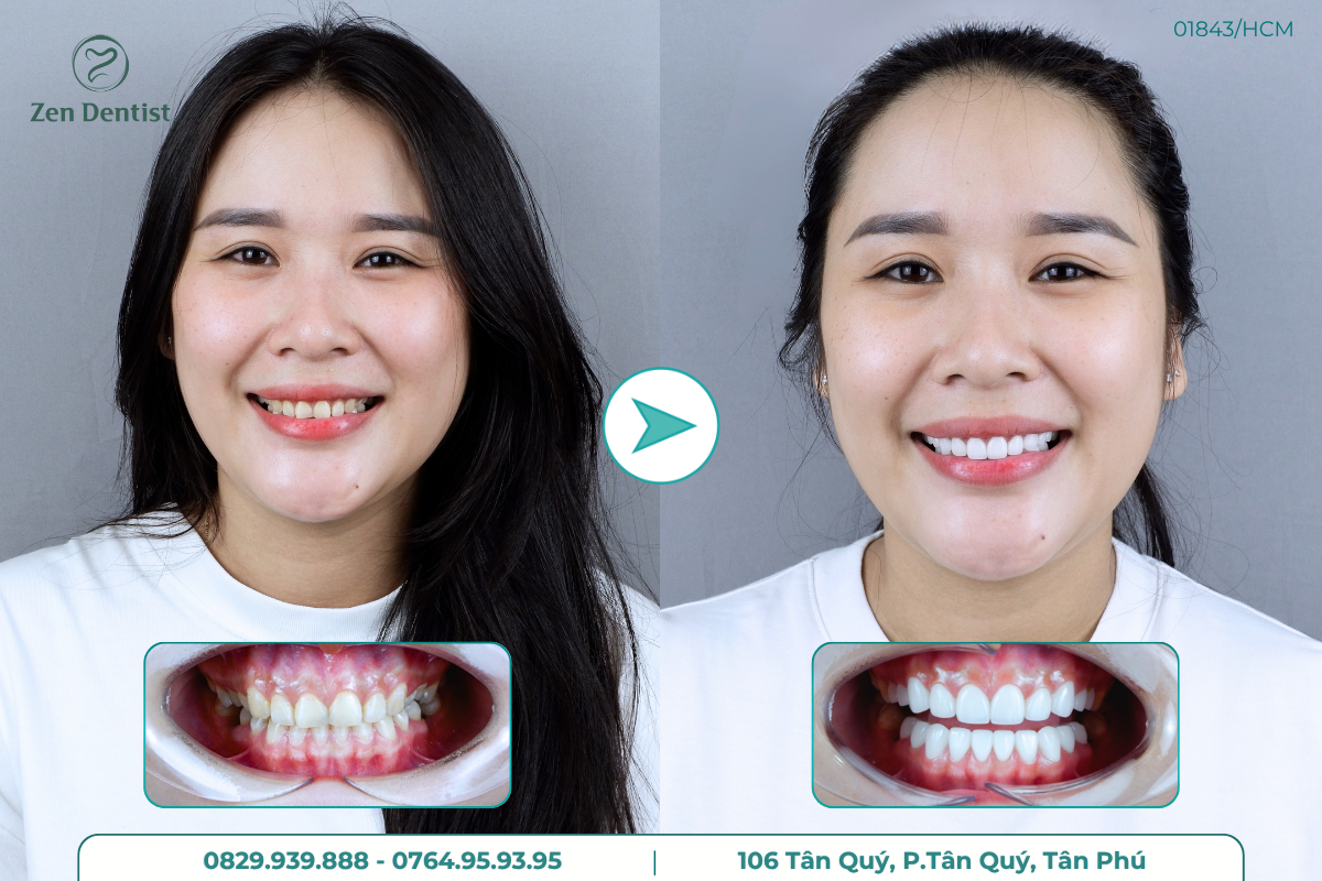 Bọc răng sứ chuẩn y khoa tại Zen Dentist