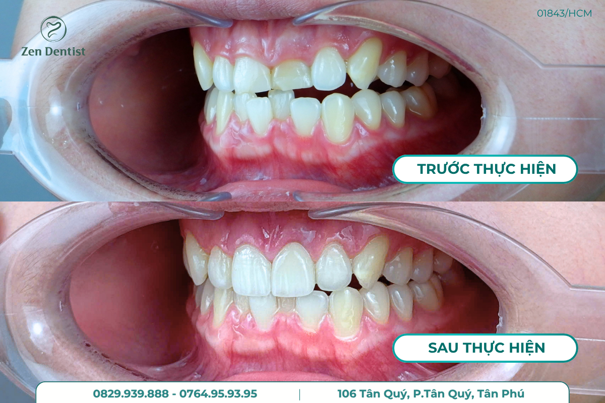 Bọc răng sứ thẩm mỹ bền đẹp