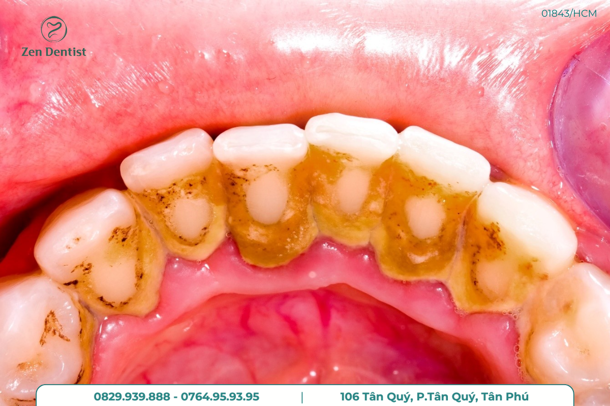 Vôi răng tích tụ do mảng bám gây mất thẩm mỹ