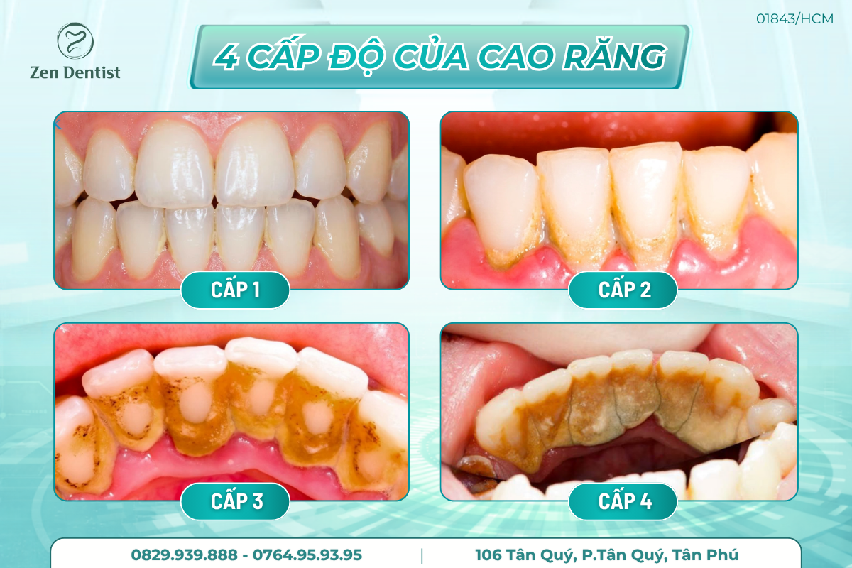 4 cấp độ của cao răng