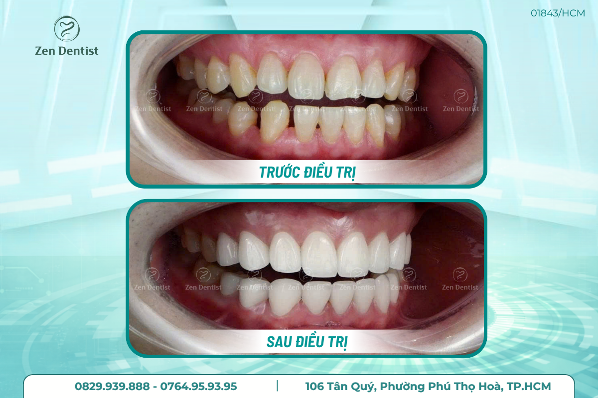 Zen Dentist là địa chỉ nha khoa bọc sứ Tân Phú uy tín