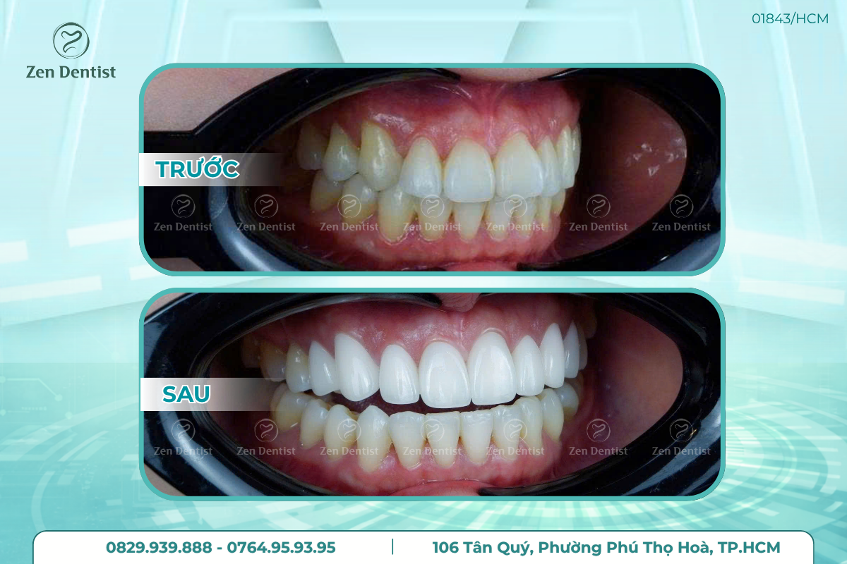 Bọc răng sứ là giải pháp cho những hàm răng gặp khuyết điểm