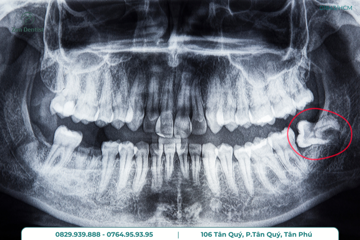 Nhổ răng bằng công nghệ hiện đại