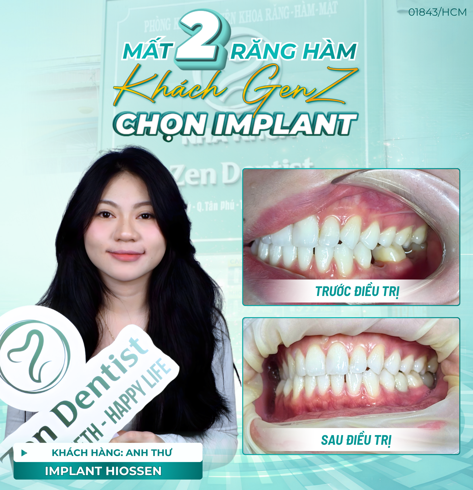 dánh gia implant