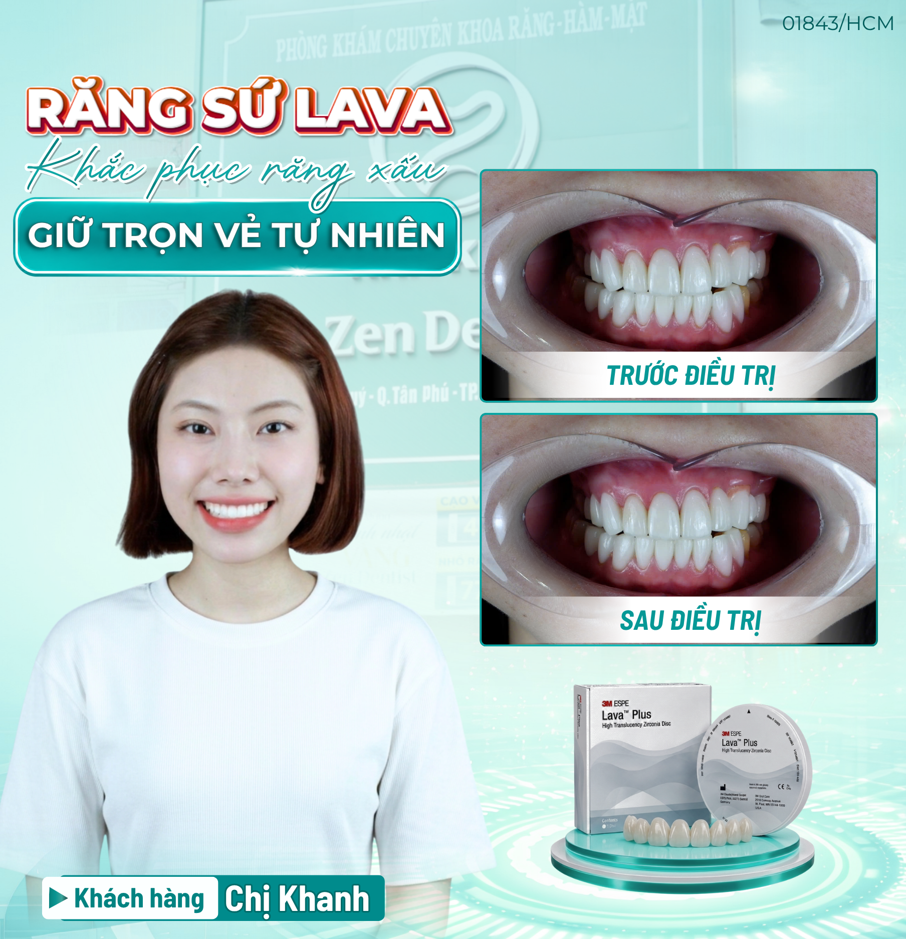 Trải nghiệm răng sứ
