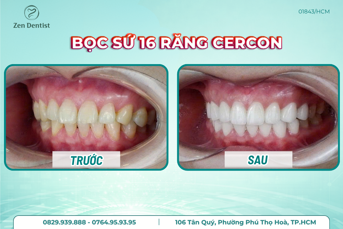 Bọc răng sứ Tân Phú không đau