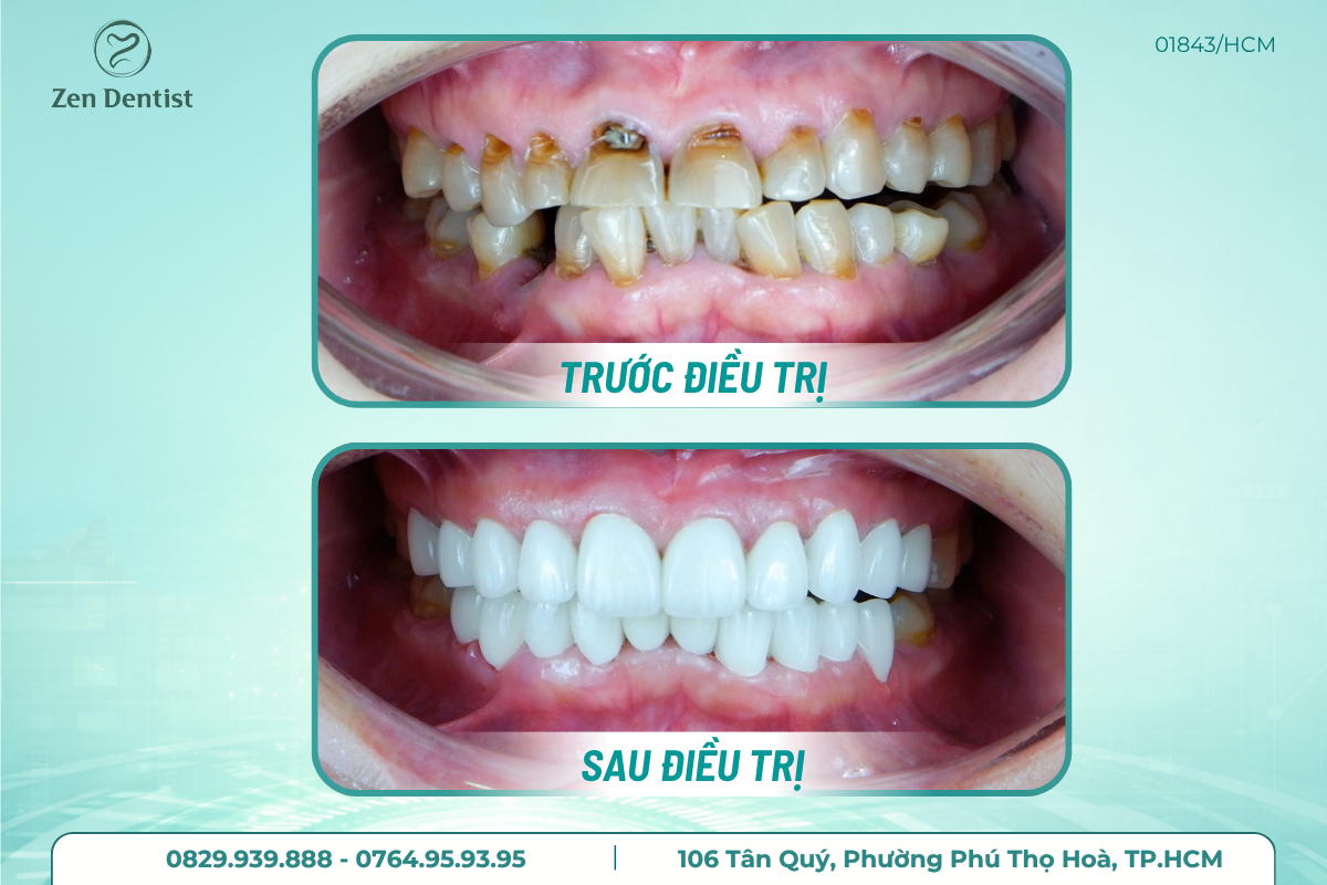 Quy trình bọc răng sứ tại Zen Dentist