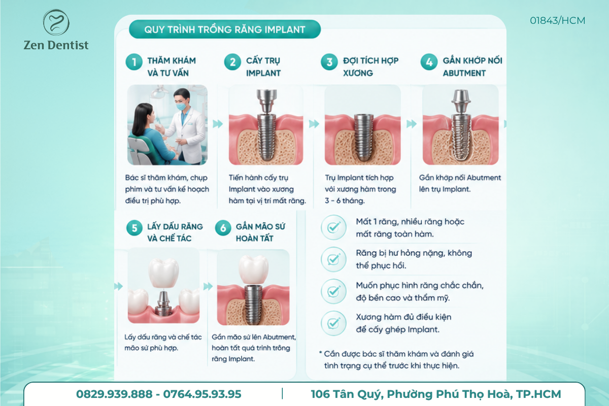Quy trình trồng răng implant tại Zen Dentist