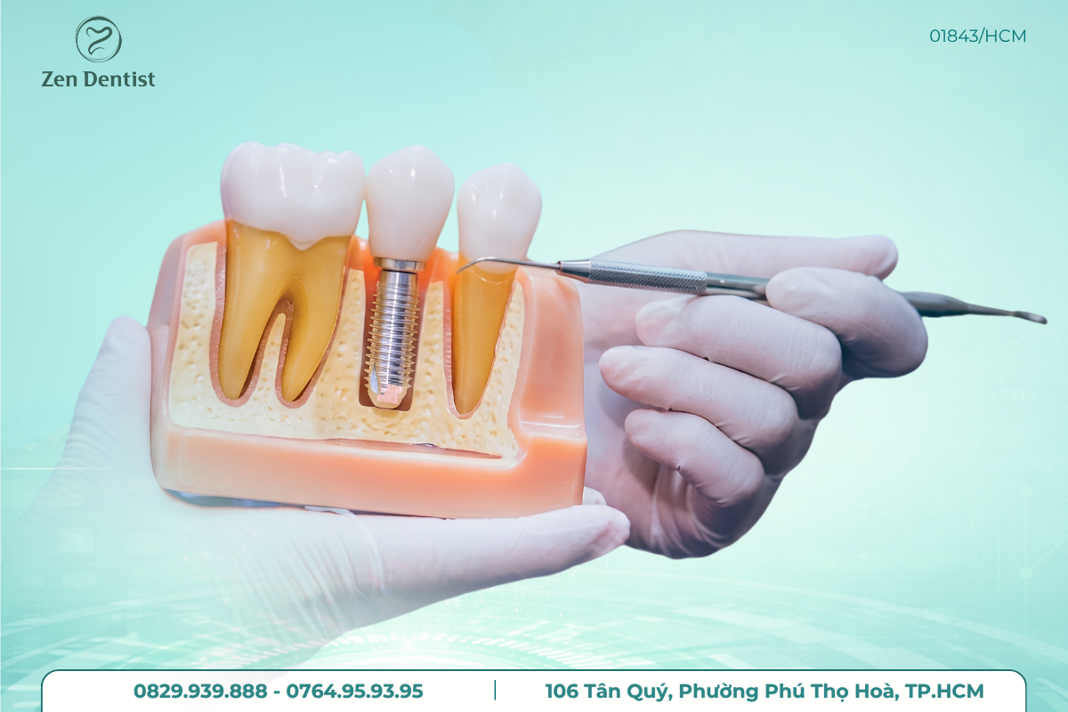 trồng implant có đau không