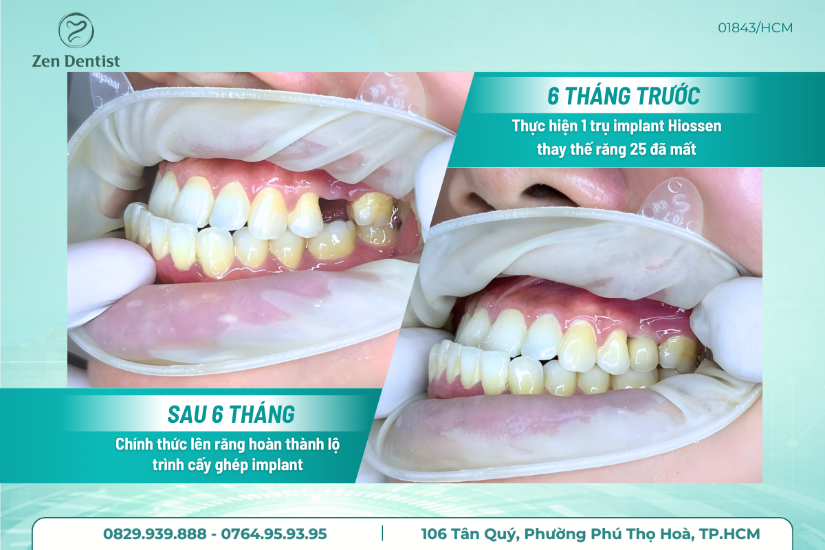 Vì sao nên chọn nha khoa trồng răng implant uy tín?