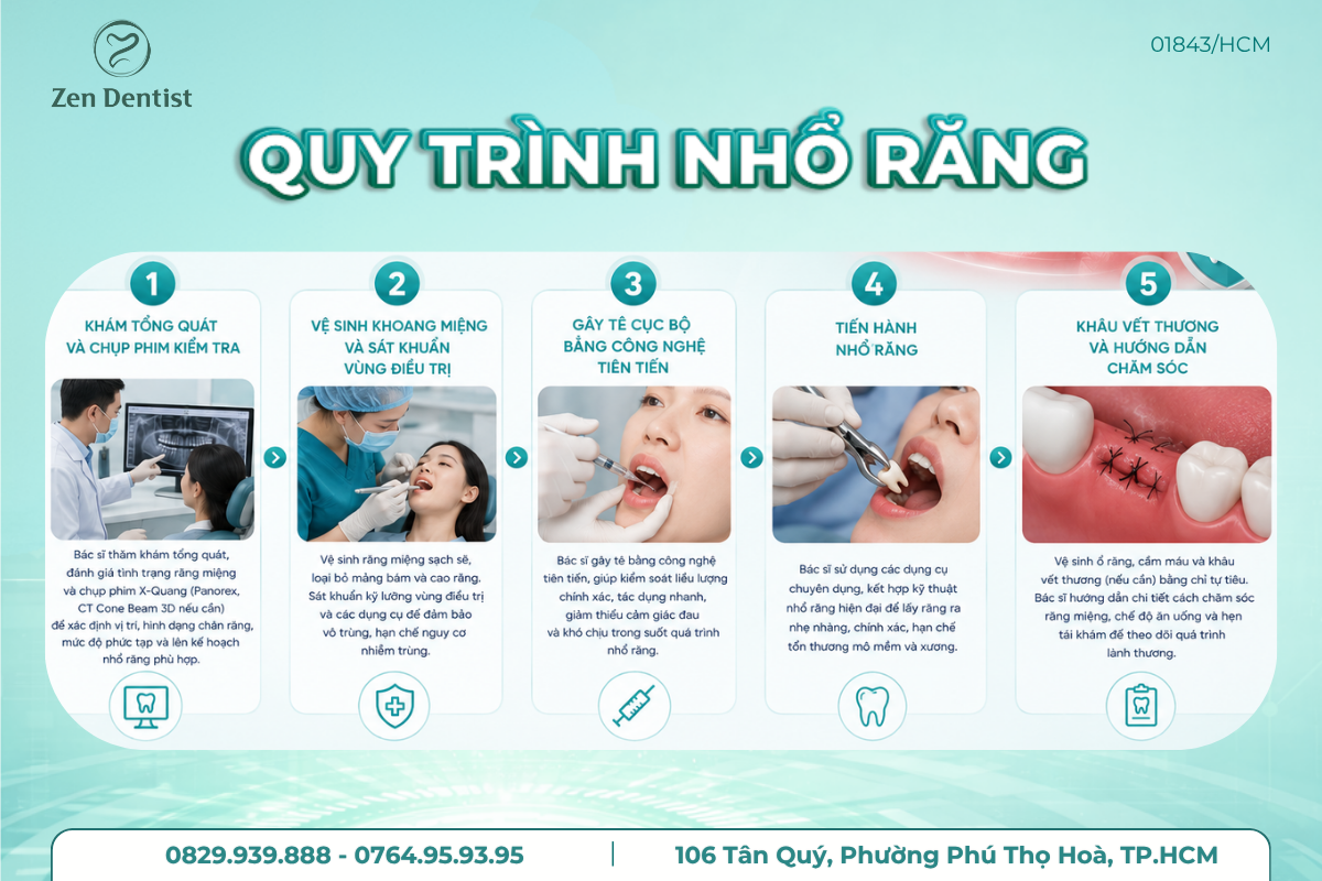 Quy trình nhổ răng chuẩn y khoa, an toàn tại Zen Dentist