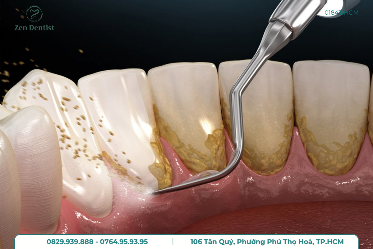 Cạo vôi răng là gì và tại sao cần cạo vôi răng định kỳ?