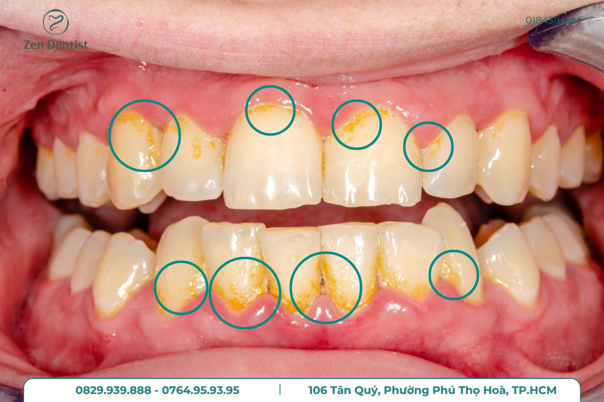 Sau khi cạo vôi răng bao lâu mới được ăn?