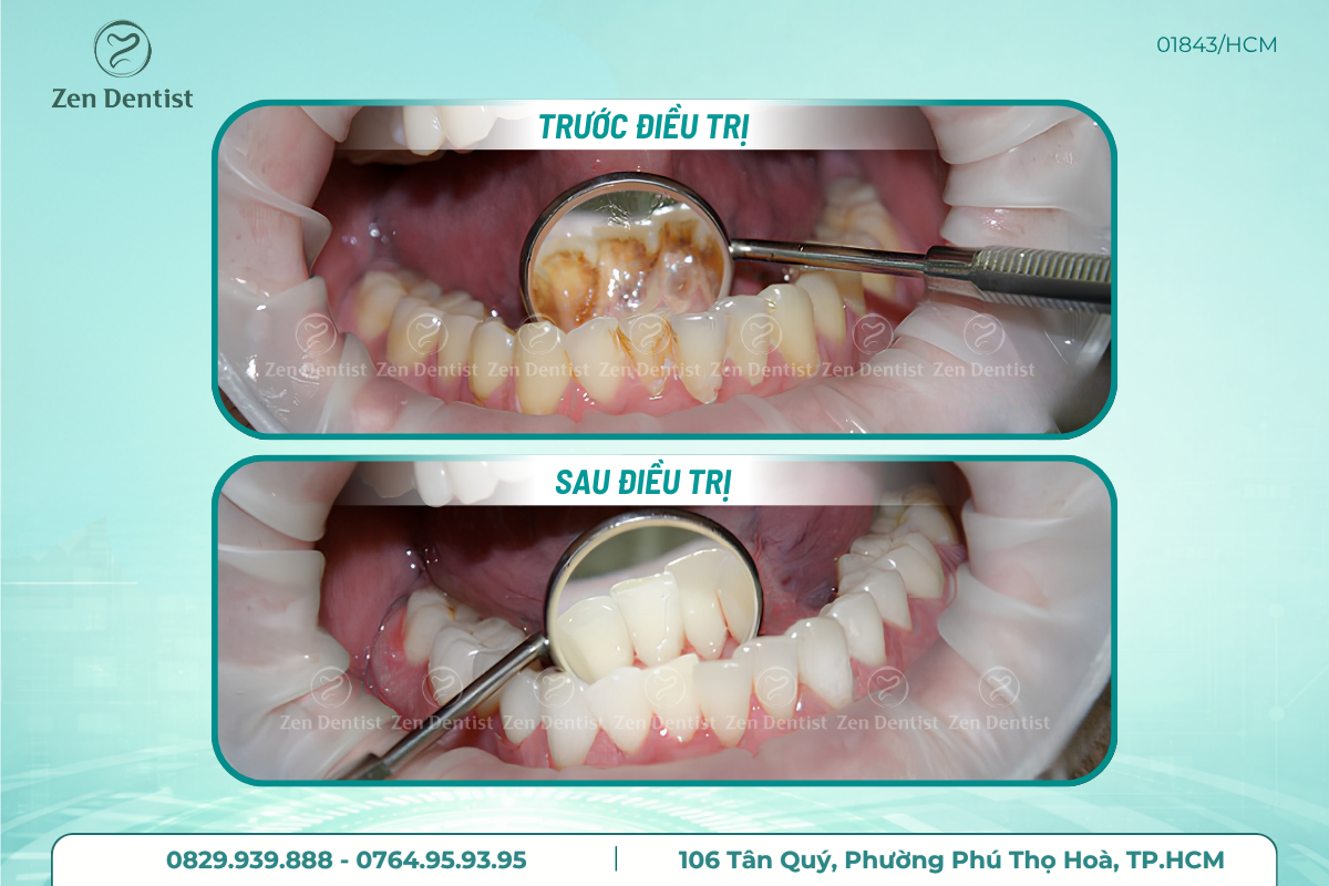 Địa chỉ cạo vôi răng an toàn tại Zen Dentist