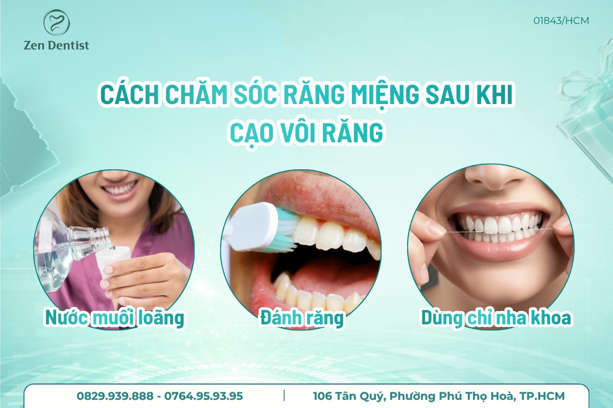 Chăm sóc răng miệng sau khi lấy cao răng