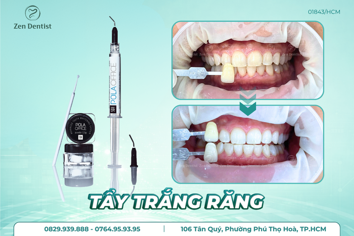 Zen Dentist địa chỉ tẩy trắng răng giá rẻ Tân Phú uy tín hàng đầu