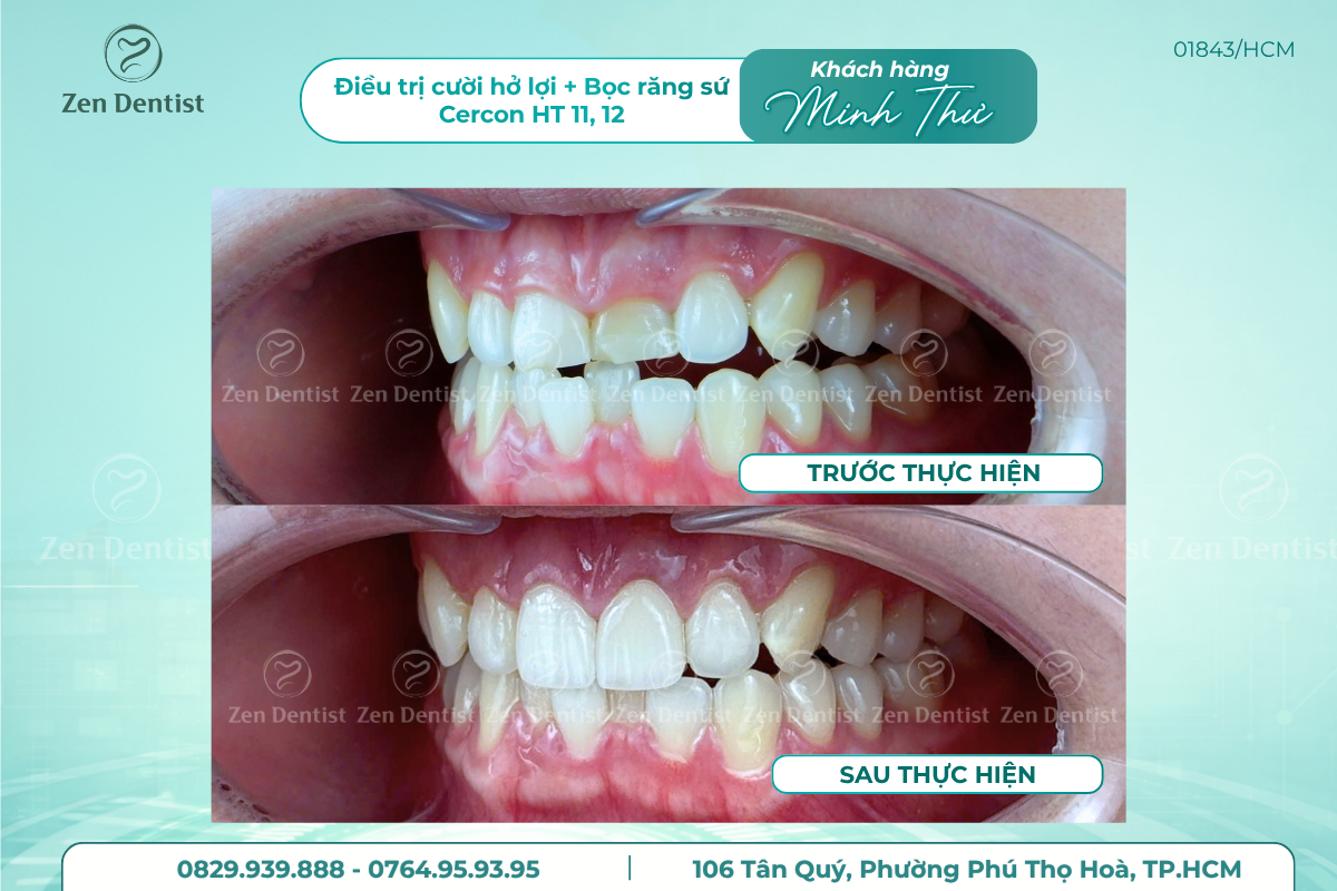 bọc răng sứ Tân Phú không đau