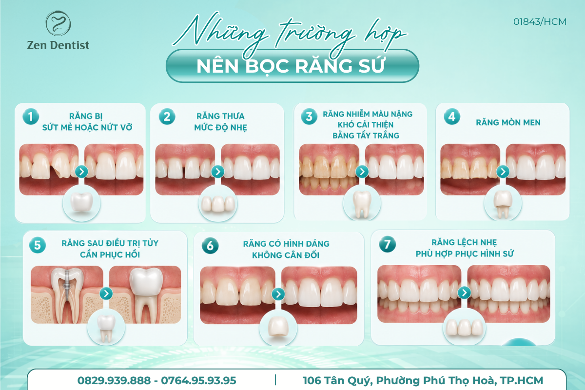 Những trường hợp nên bọc răng sứ