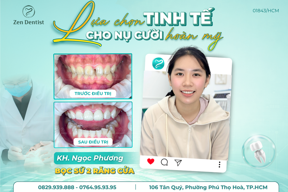 Quy trình bọc răng sứ chuẩn nha khoa 