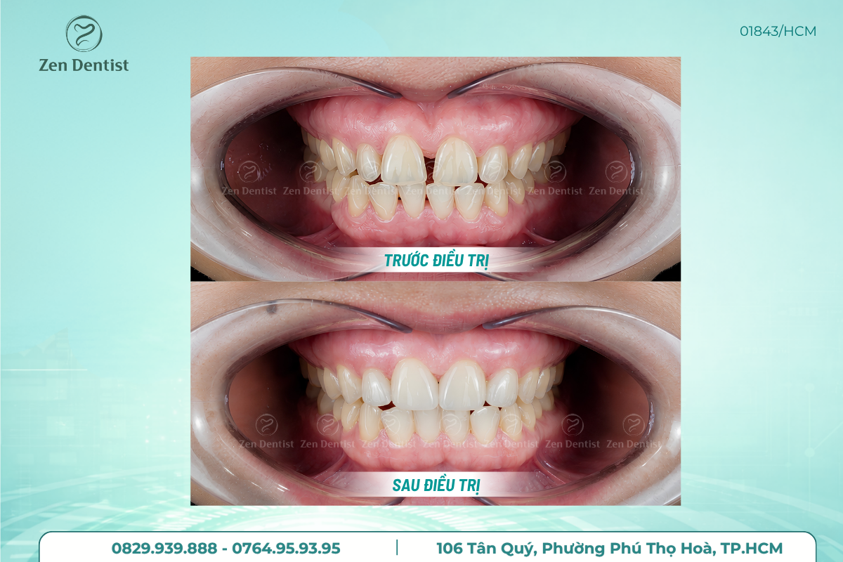 Bọc răng sứ cho răng thưa
