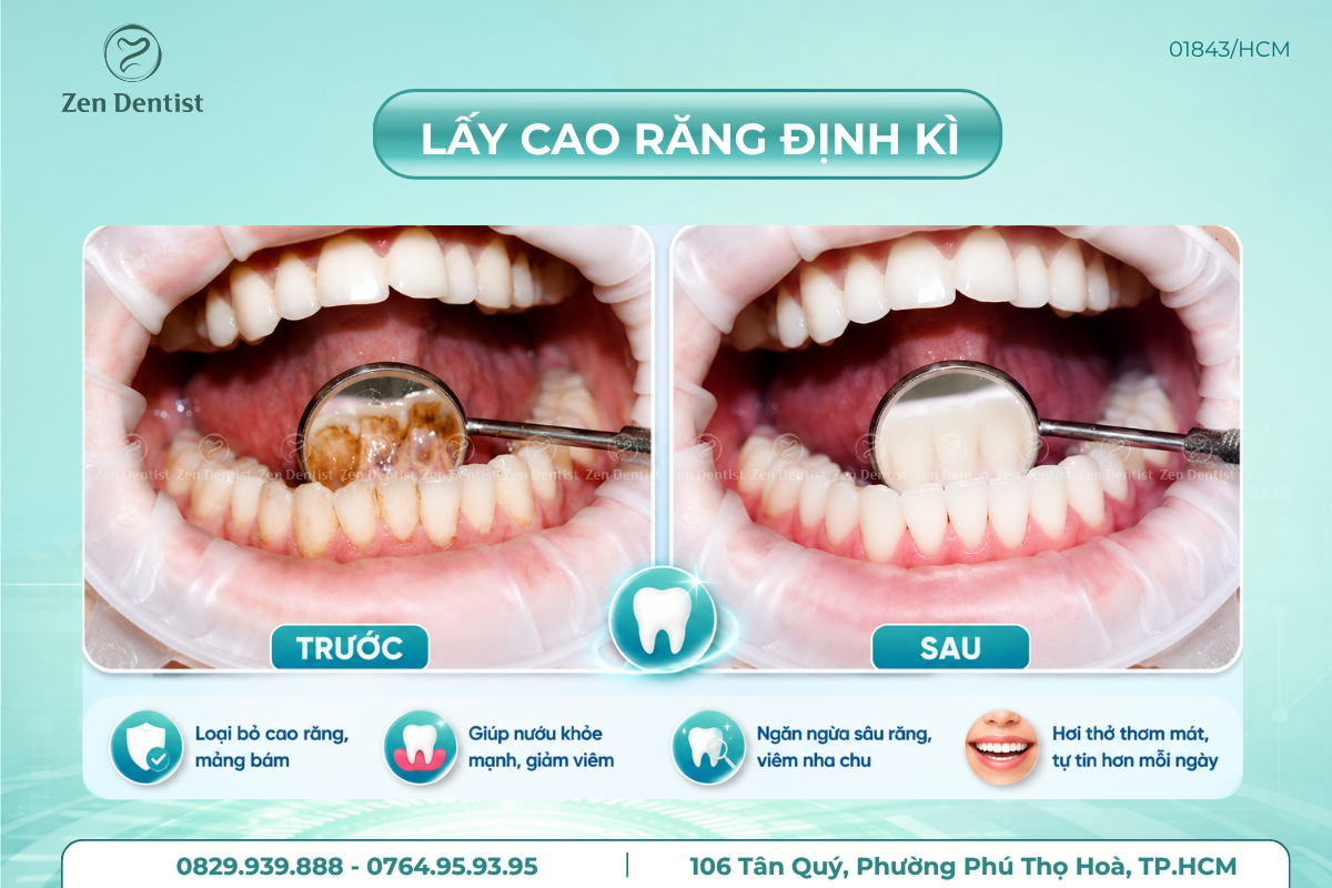 Cao răng để lâu có sao không?