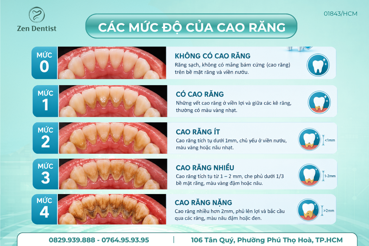 Các mức độ của cao răng