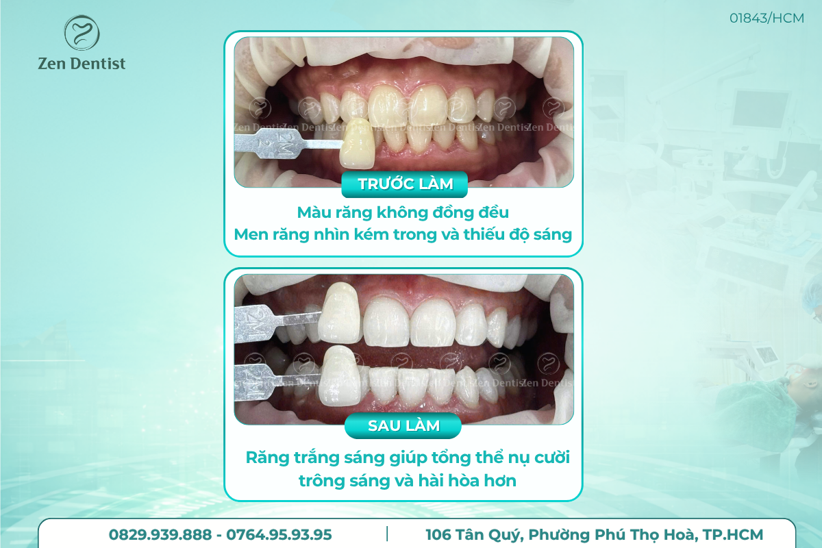 Vì sao chi phí tẩy trắng răng ở mỗi người lại khác nhau?