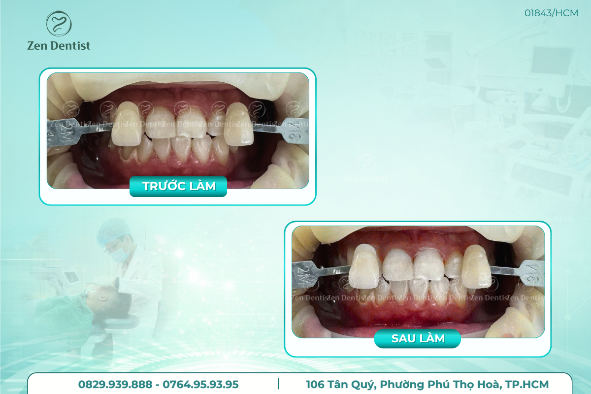 Tẩy trắng răng an toàn tiết kiệm chi phí tại Zen Dentist