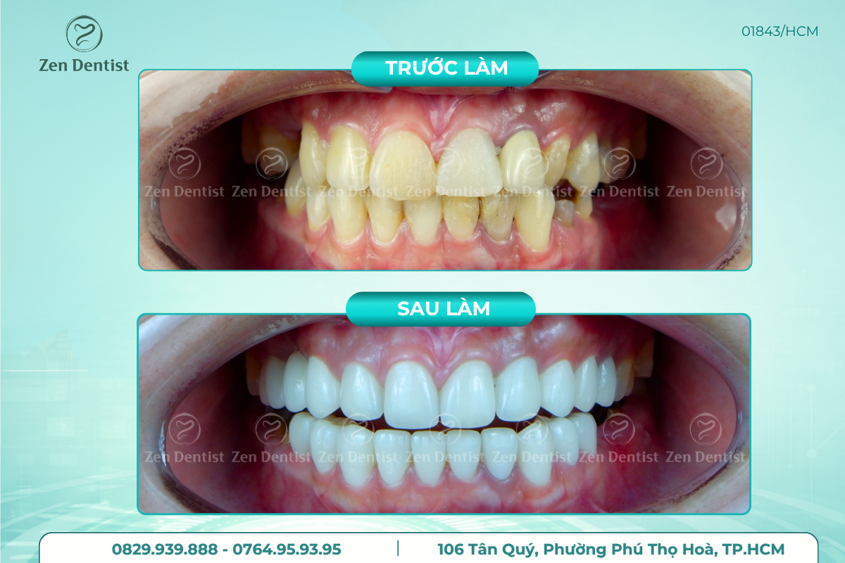 dấu hiệu răng sứ bị hư 