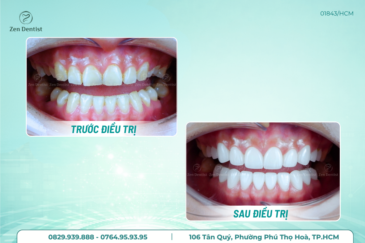 Làm răng sứ chất lượng uy tín tại Zen Dentist