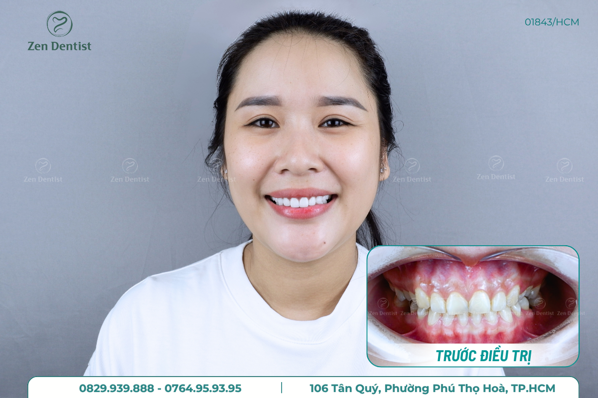 Bọc răng sứ tại Zen Dentist lấy lại nụ cười tự tin