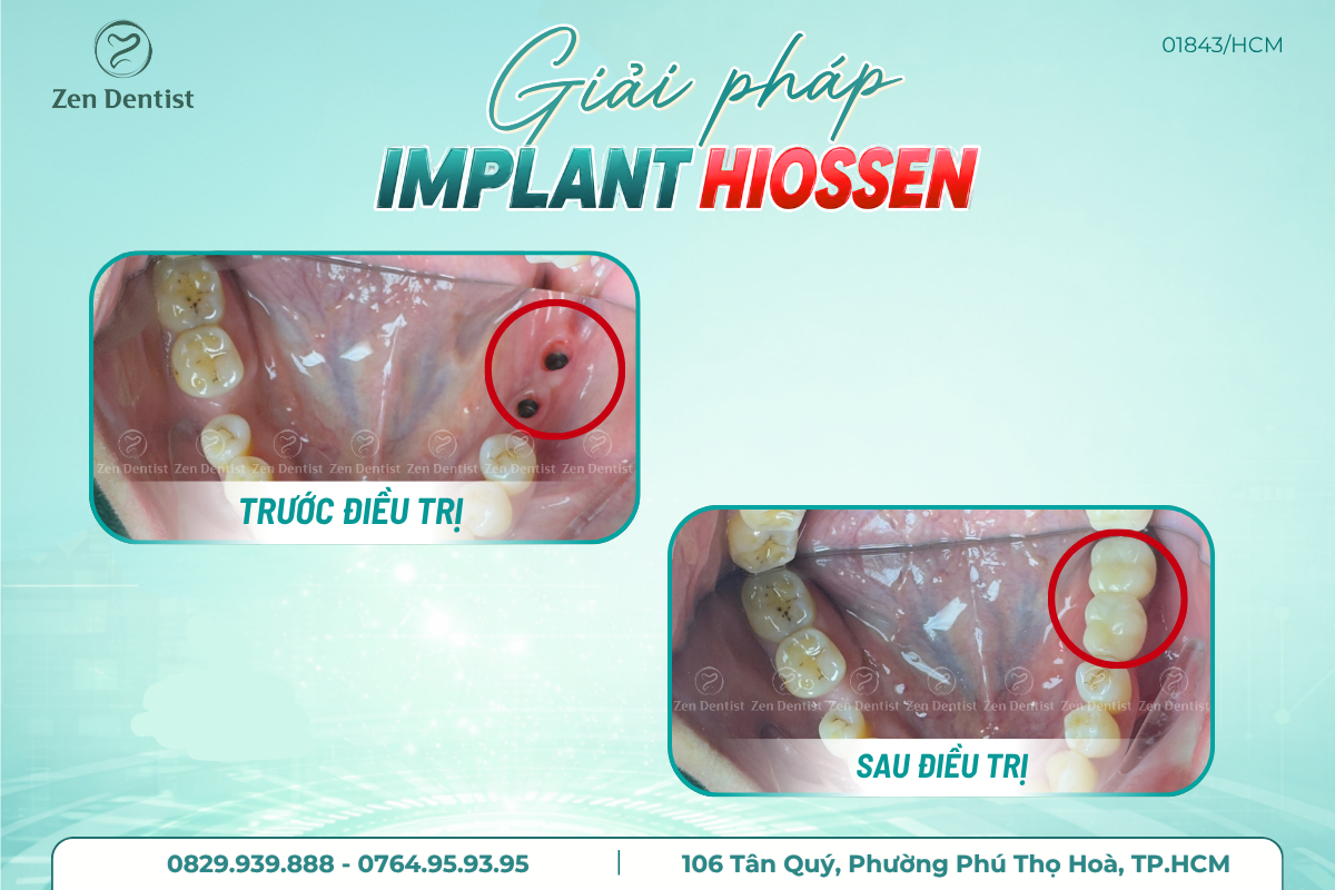 Quy trình trồng Implant tại Zen Dentist