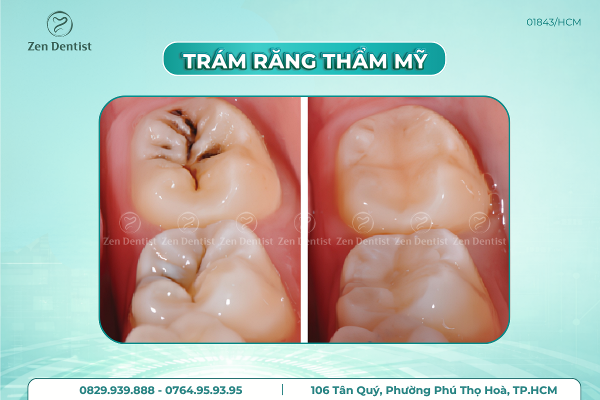 Trám răng thẩm mỹ