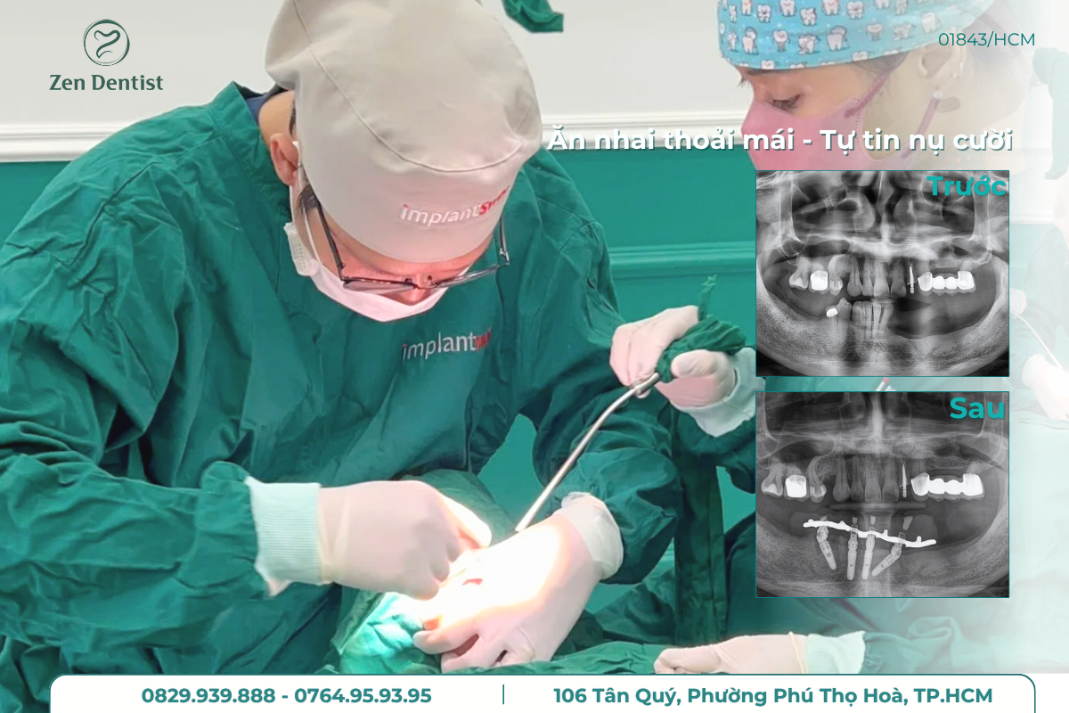 Zen Dentist nha khoa trồng implant Tân Phú cho nụ cười đẹp
