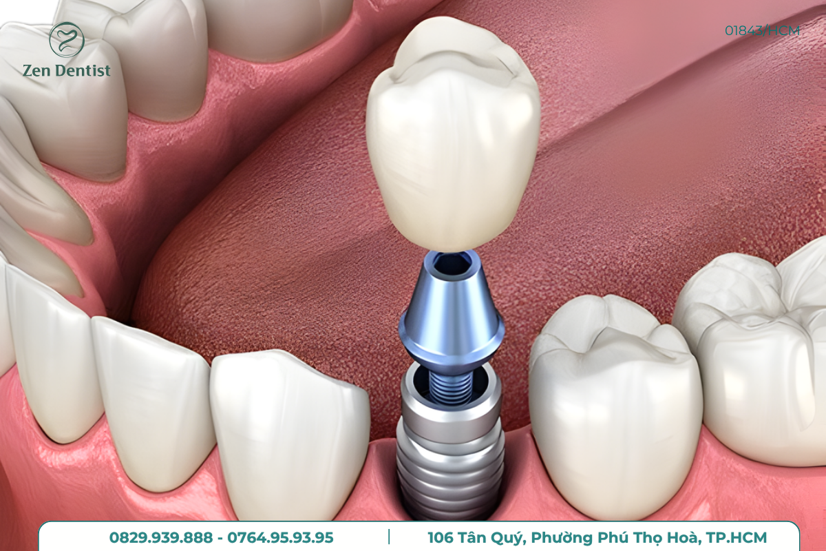 Phương pháp trồng Implant