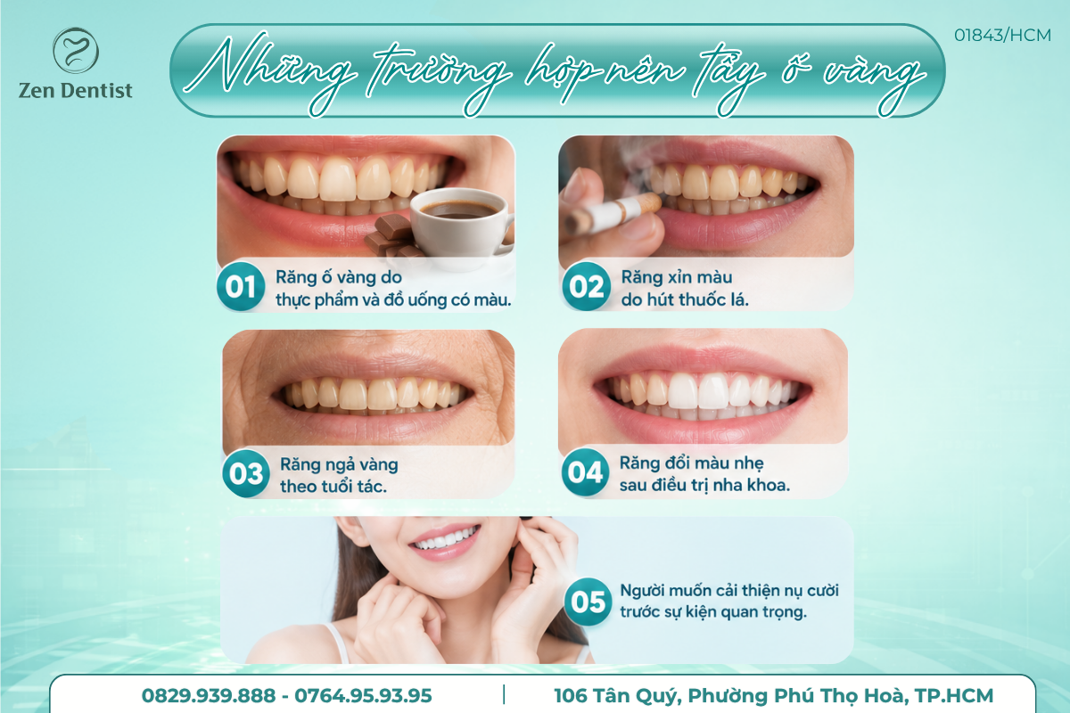 Những trường hợp nên tẩy trắng răng