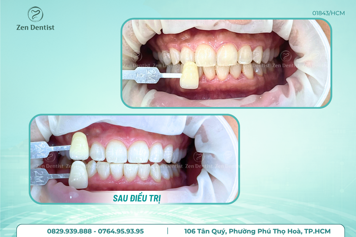 Vì sao nhiều khách hàng lựa chọn tẩy trắng răng tại Zen Dentist?