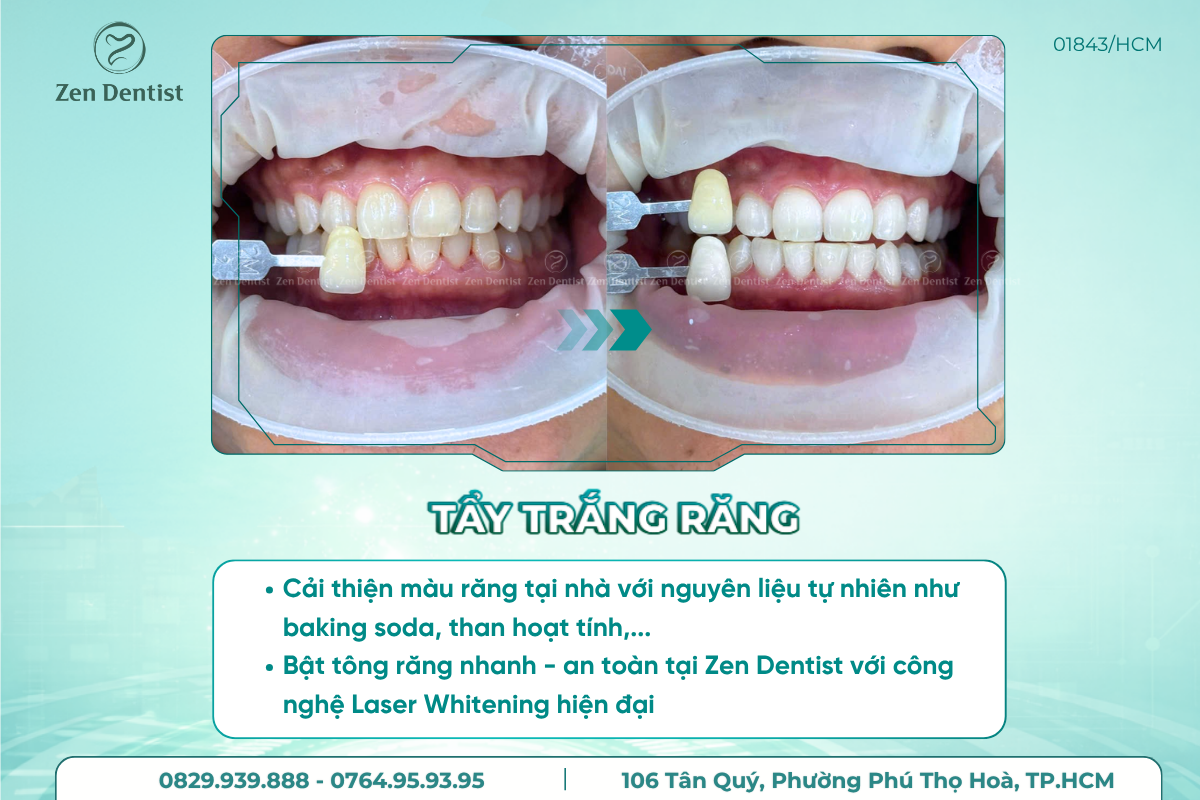 Nguyên nhân khiến tẩy trắng răng bị bỏng nướu