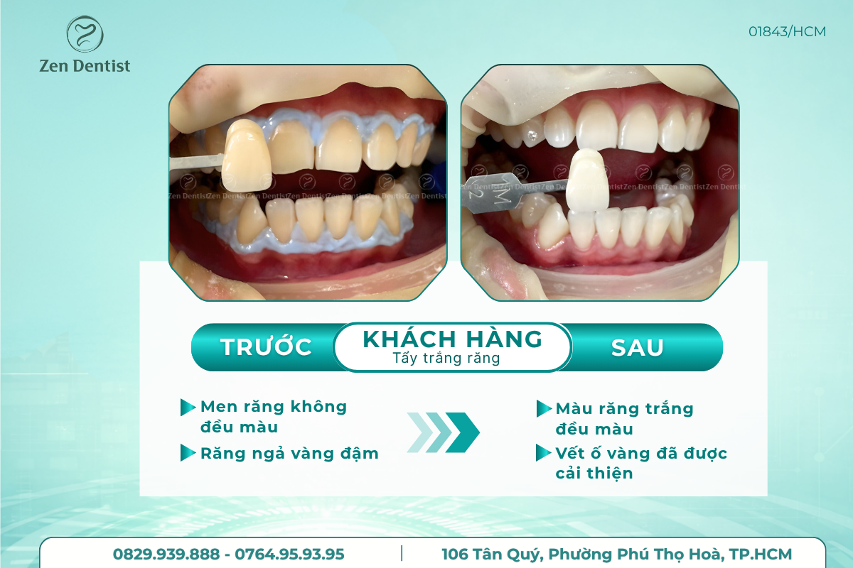 Vì sao khách hàng tin chọn tẩy trắng răng tại Zen Dentist?