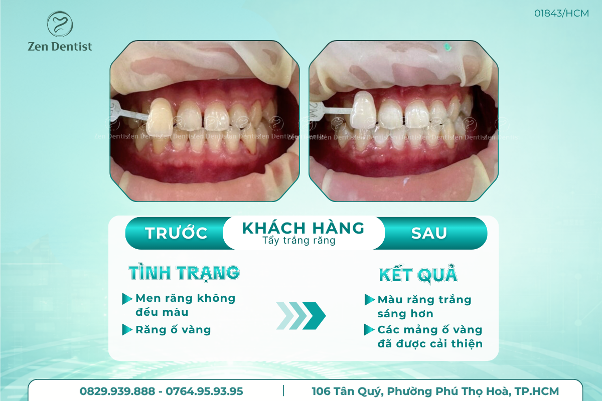Những hiểu lầm về tẩy trắng răng