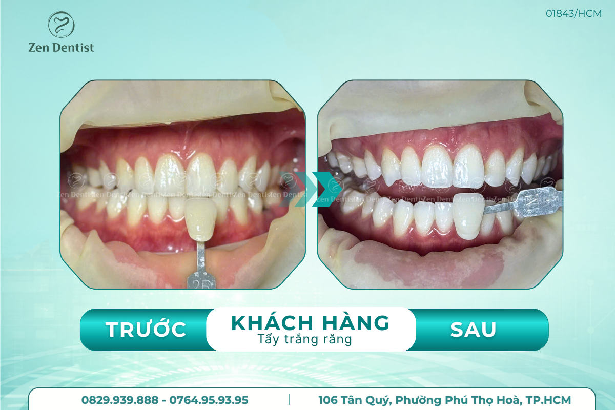 Tẩy trắng răng có làm mòn men răng không?