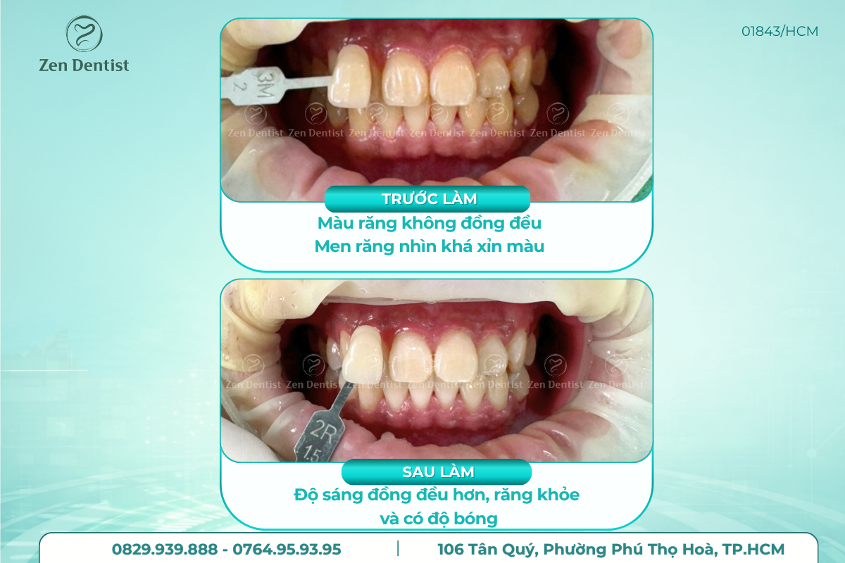Zen Dentist - Địa chỉ tẩy trắng răng giá rẻ Tân Phú